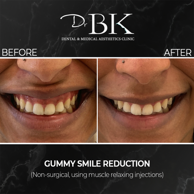 Before & After Gummy Smile Treatment Before & After Gummy Smile Treatment