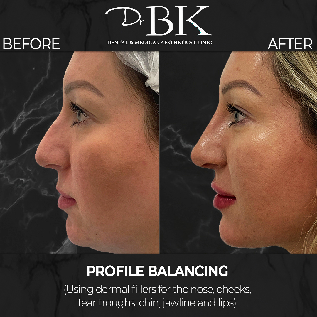 Profile Balancing (using dermal fillers) at DrBK - Before and After Transformation