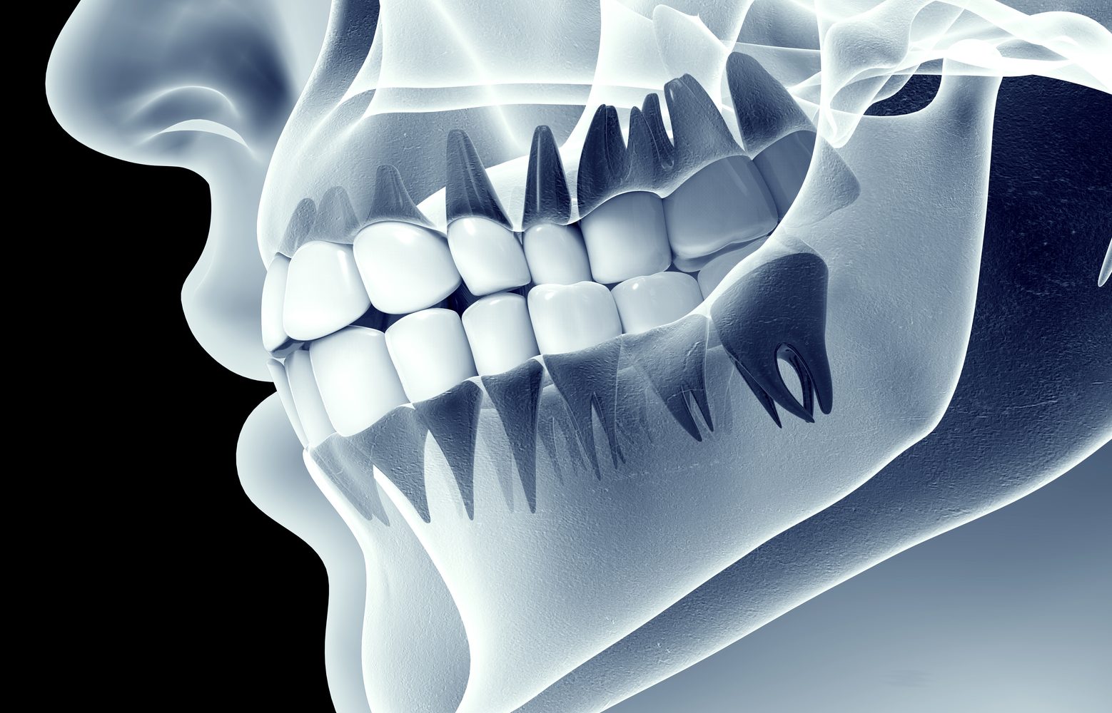 x-ray image of a jaw with teeth