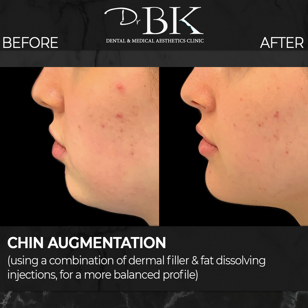 Chin-fillerandfat Chin-fillerandfat