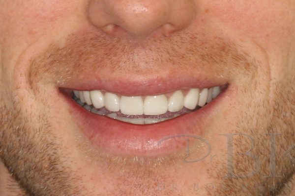 After Full Smile Makeover at DrBK After Full Smile Makeover at DrBK