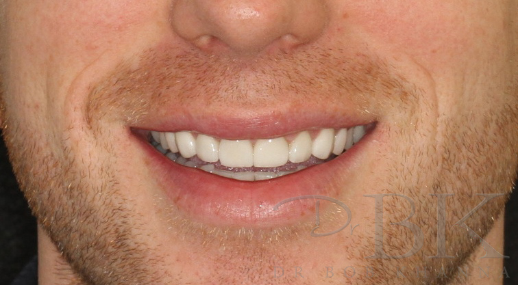 After Full Smile Makeover at DrBK After Full Smile Makeover at DrBK