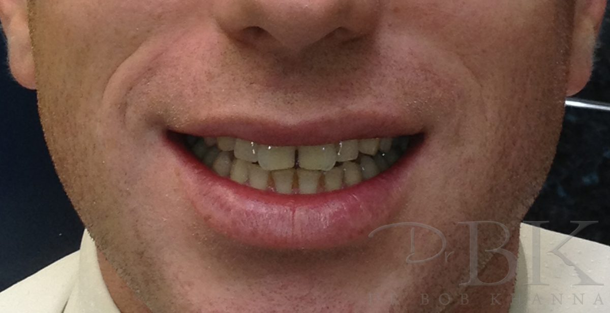 Before Full Smile Makeover at DrBK Before Full Smile Makeover at DrBK