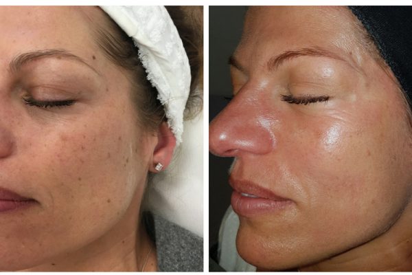 Before & After Clearlift
