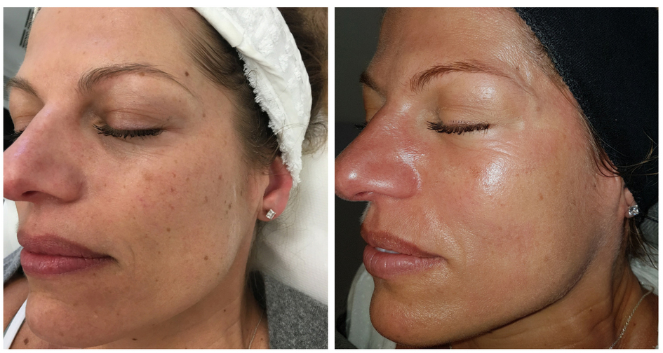 Before & After Clearlift