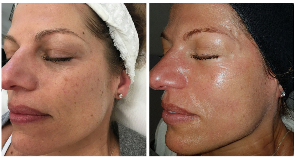 Clearlift Facial Rejuvenation DrBK Aesthetics Clinic in Reading