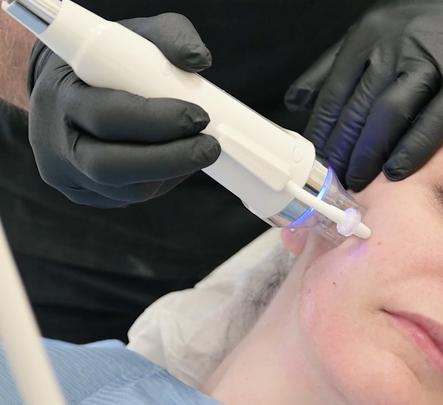 CutisLift (Radio frequency micro-needling) - Step 1 of the DrBK Non-Surgical FaceLift
