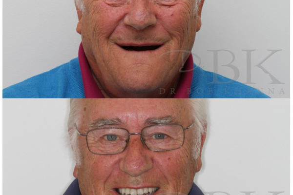 Dentures at DrBK - Implant retained Dentures at DrBK - Implant retained