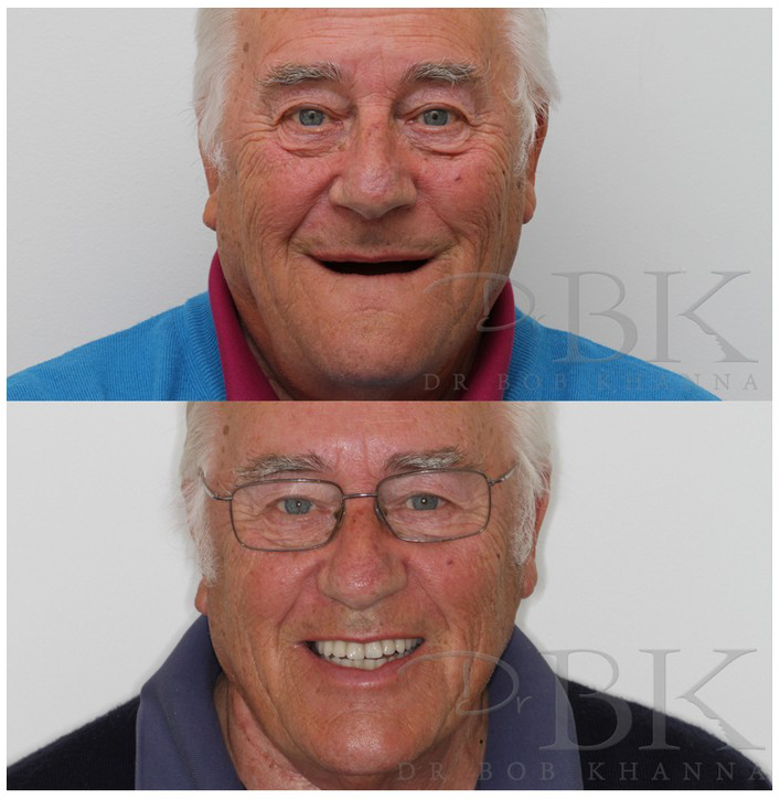 Dentures at DrBK - Implant retained