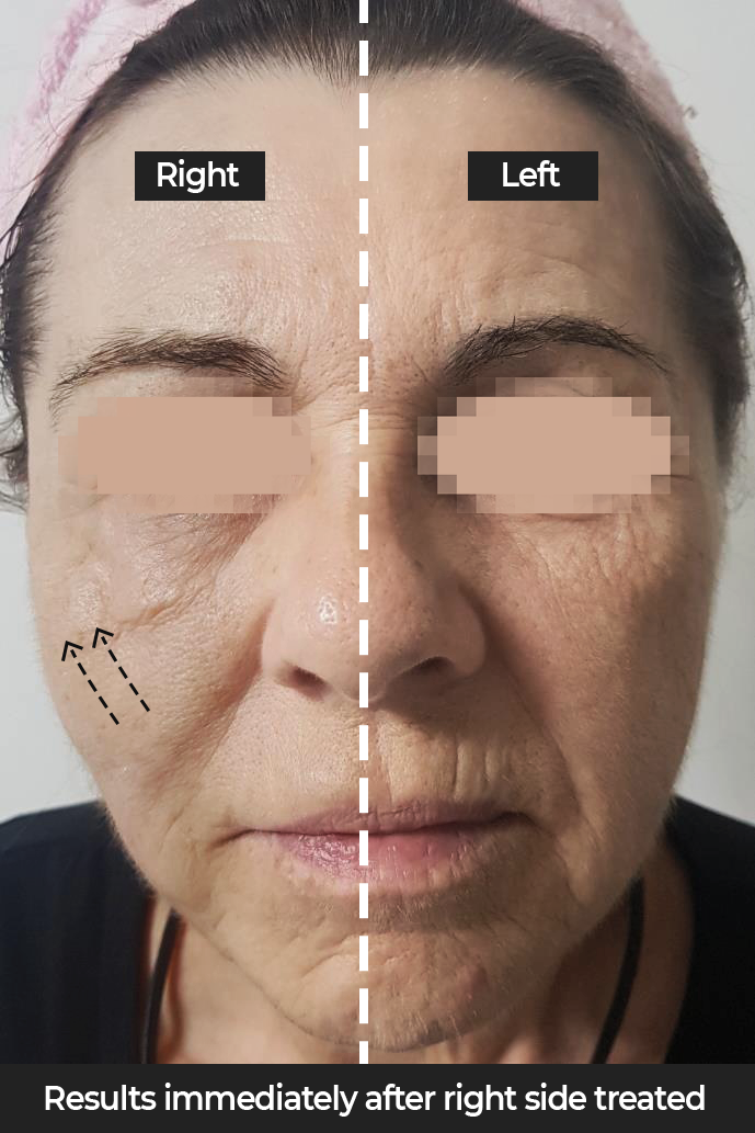 Dual-Hi Advanced Skin Tightening at DrBK