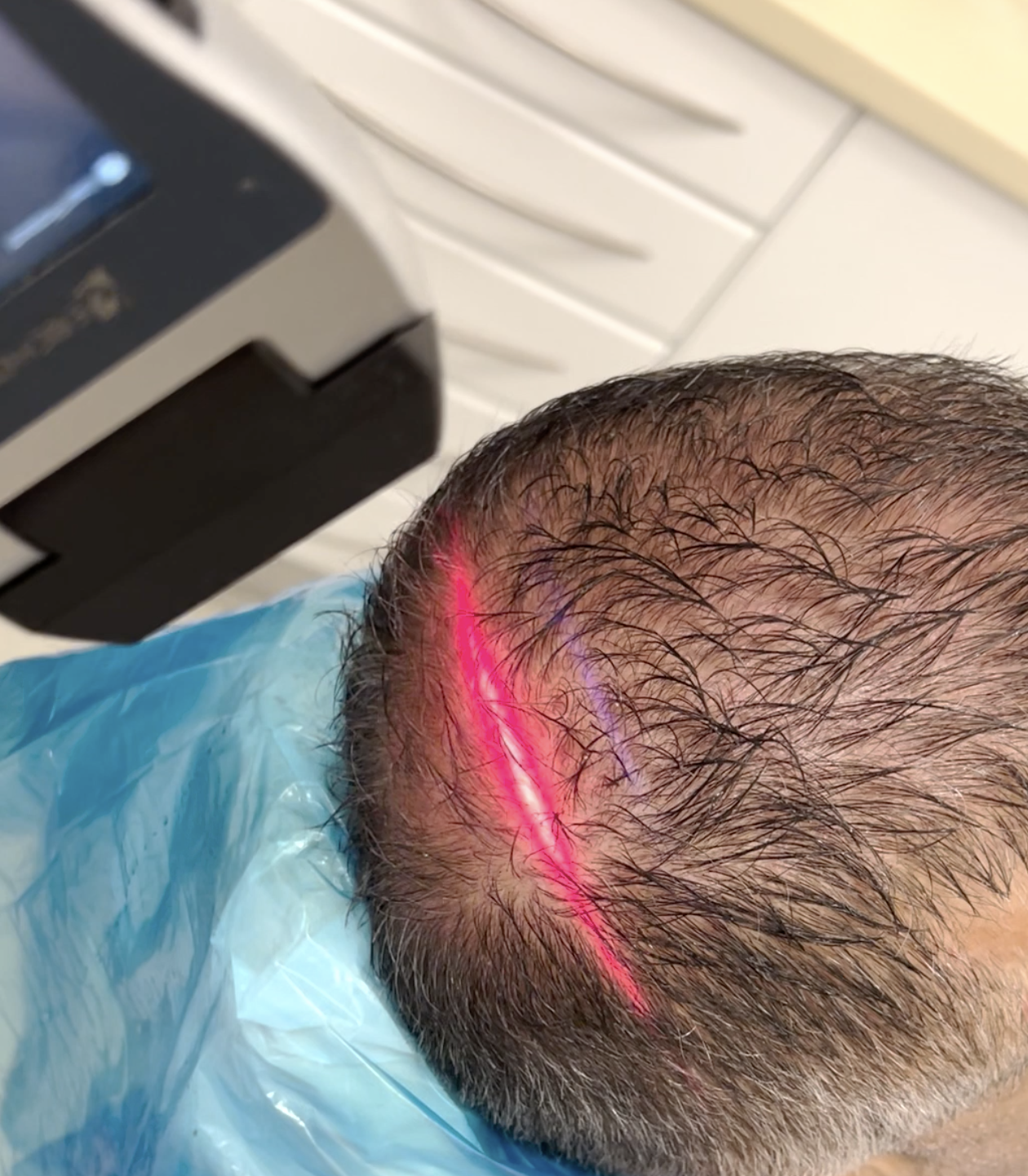 EVRL for stimulating hair follicles and promoting healing