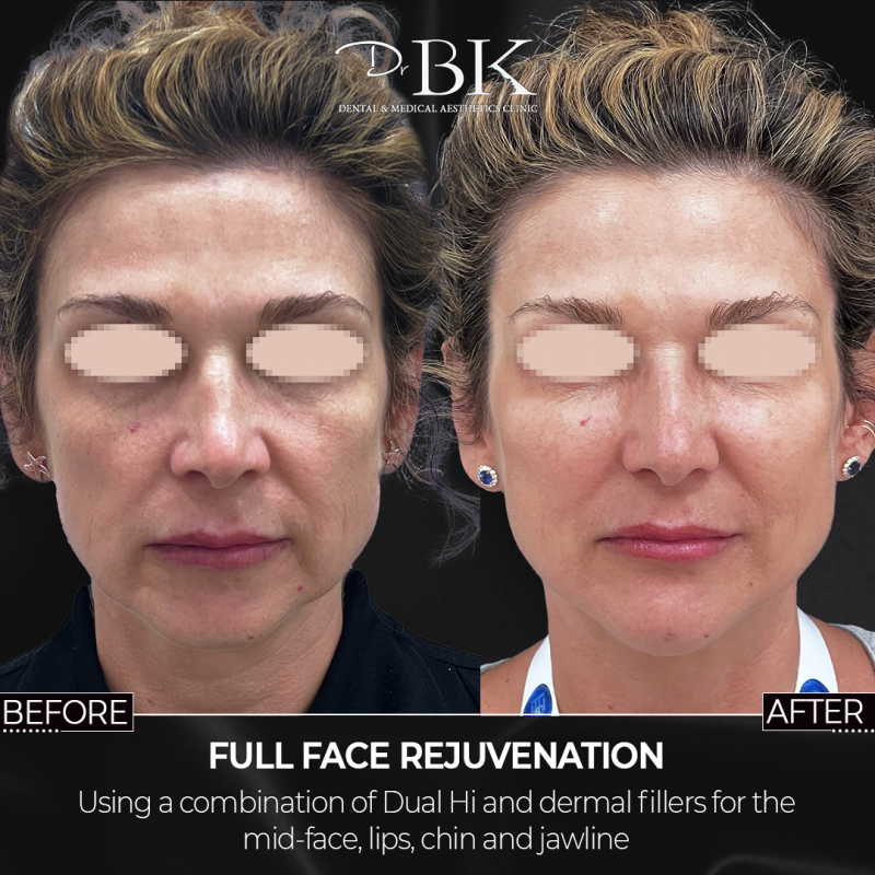 Before and After Dual Hi (HiFU) Before and After Dual Hi (HiFU)