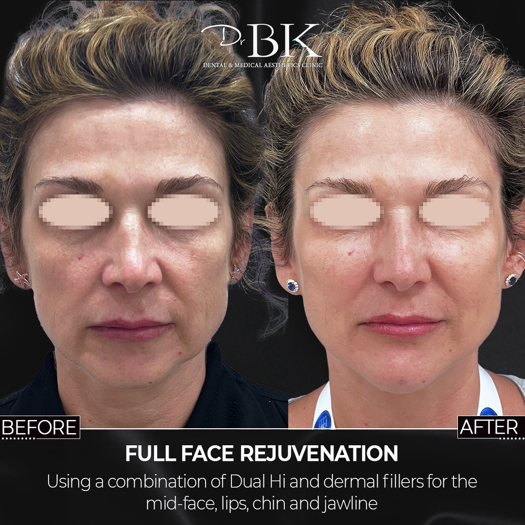 Before and After Dual Hi (HiFU) Before and After Dual Hi (HiFU)