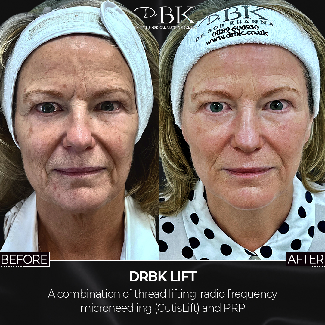 Front-BeforeandAfter