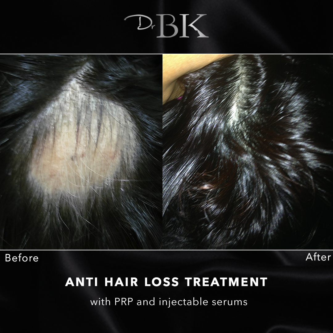 Anti hair loss treatment DrBK Reading Berkshire