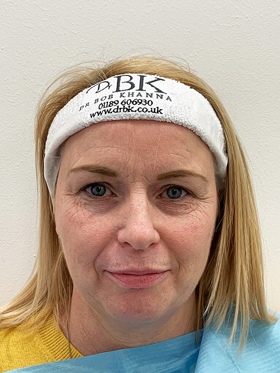 Before Thread Lifting Before Thread Lifting