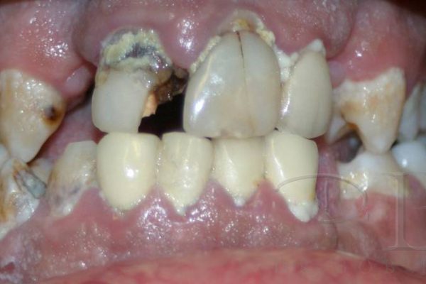 Before Full Smile Makeover at DrBK Before Full Smile Makeover at DrBK