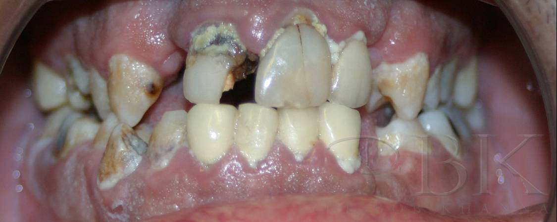 IMPLANT & CROWNS BEFORE