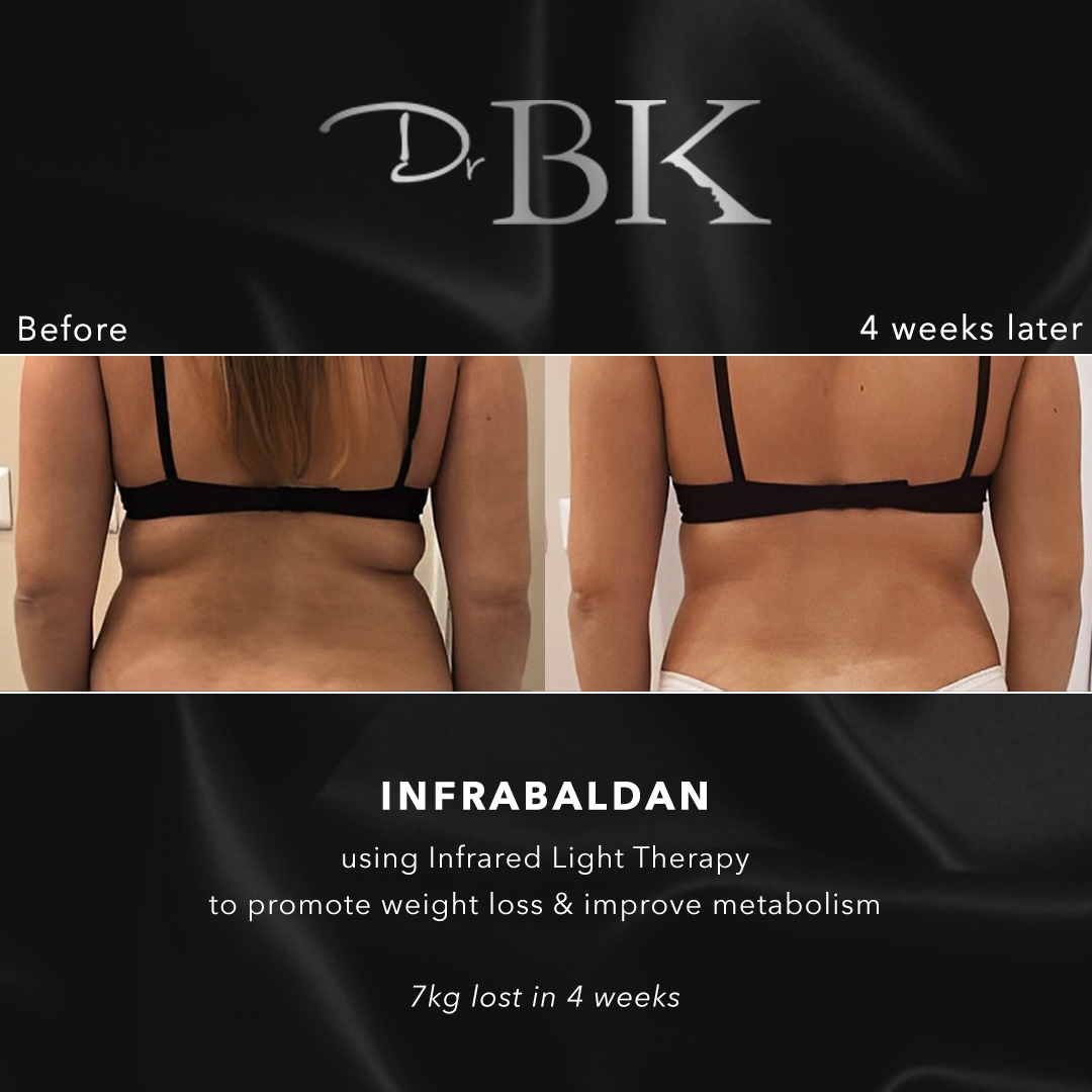 InfraBaldan laser treatment for fat loss - Photo showing patient with 7kg loss in 4 weeks