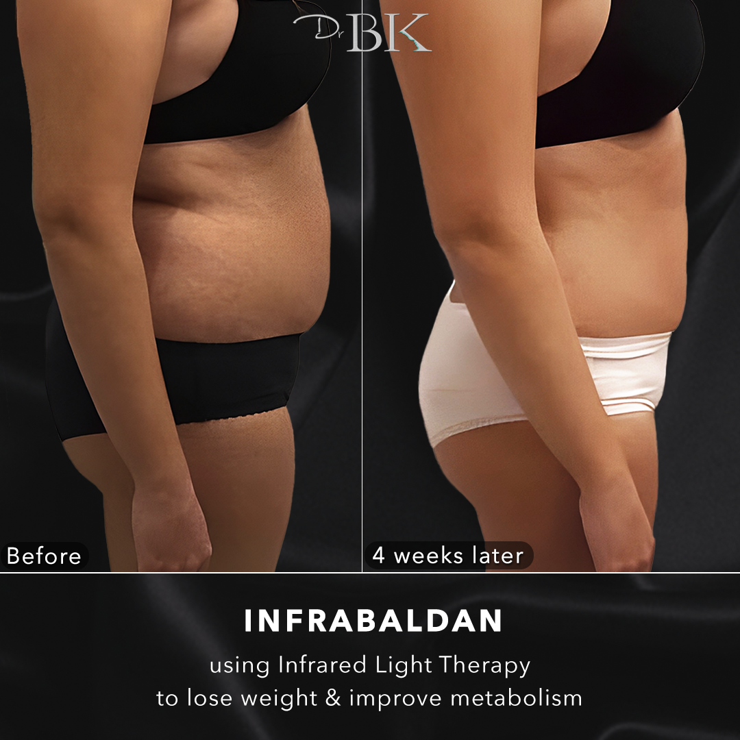 InfraBaldan laser treatment for fat loss - Photo showing patient with 7kg loss in 4 weeks