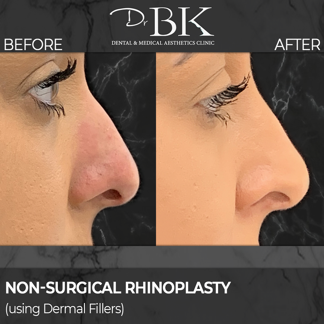 Non-surgical rhinoplasty before and after
