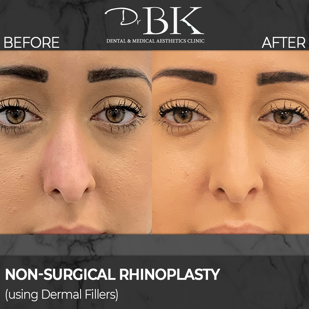 Non-surgical rhinoplasty before and after