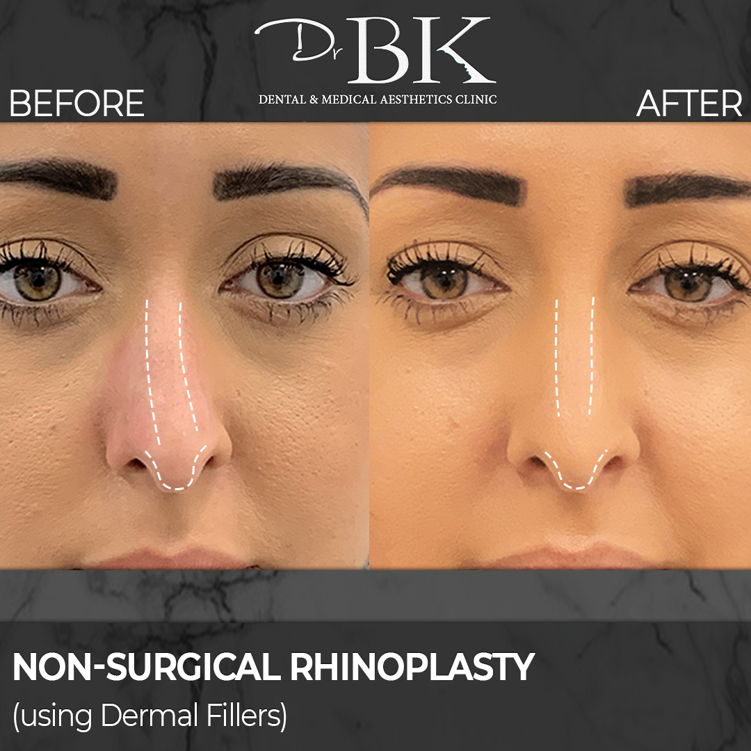 Non-surgical rhinoplasty before and after