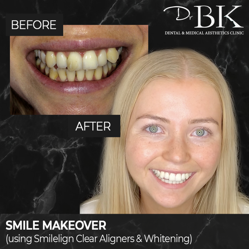 Before and After Smilelign Clear Aligners and Whitening at DrBK