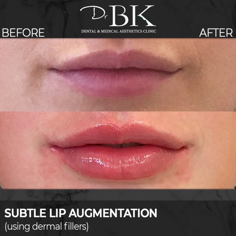 Lip Augmentation: Before & After (Subtle)