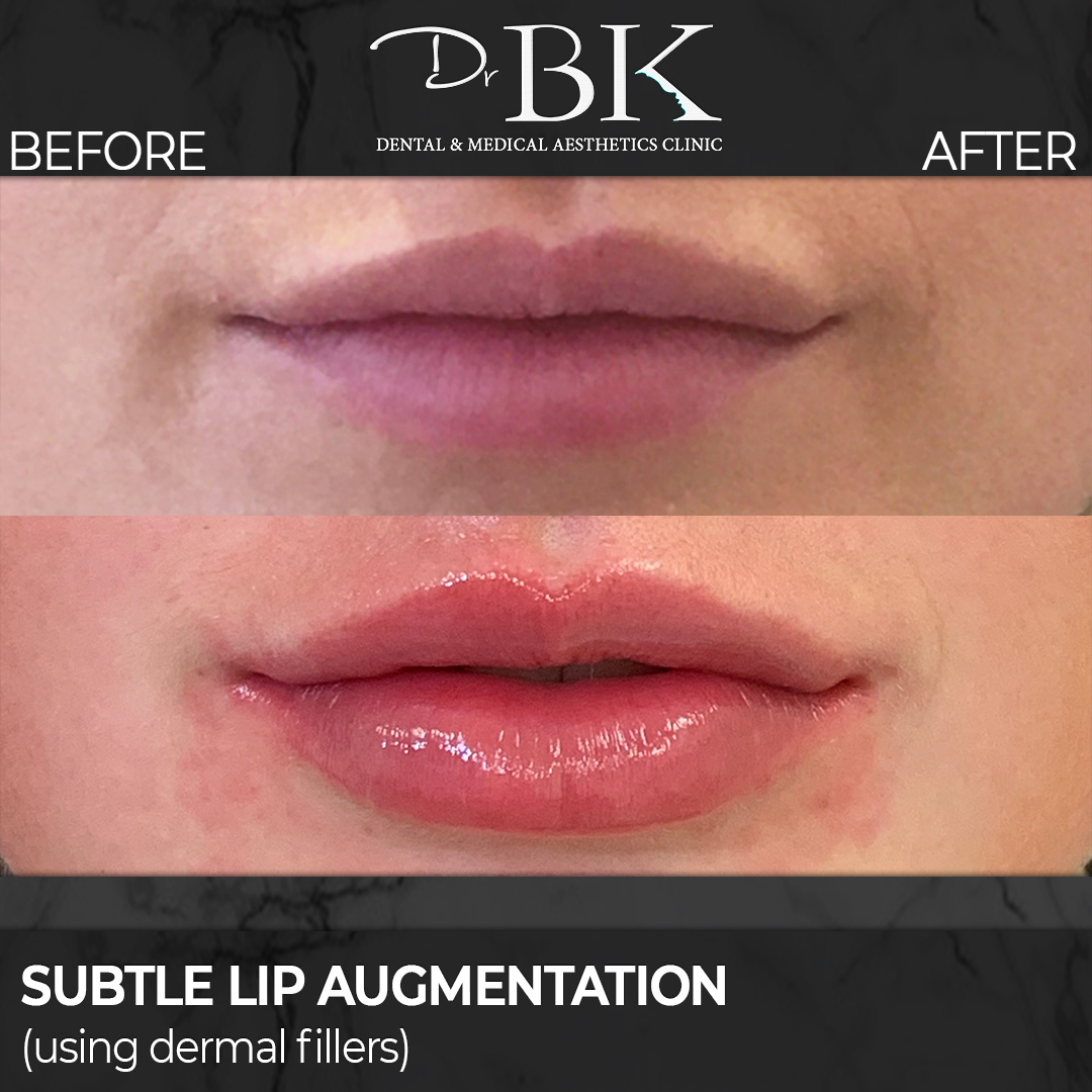 Lip Augmentation: Before & After (Subtle)