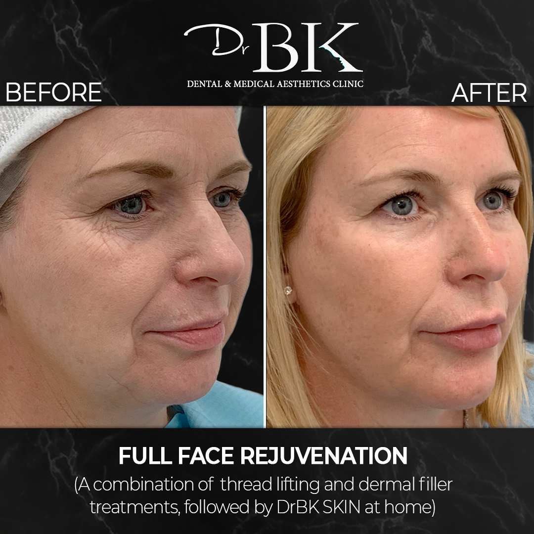 Lisa-Front-BeforeAfter-3-4