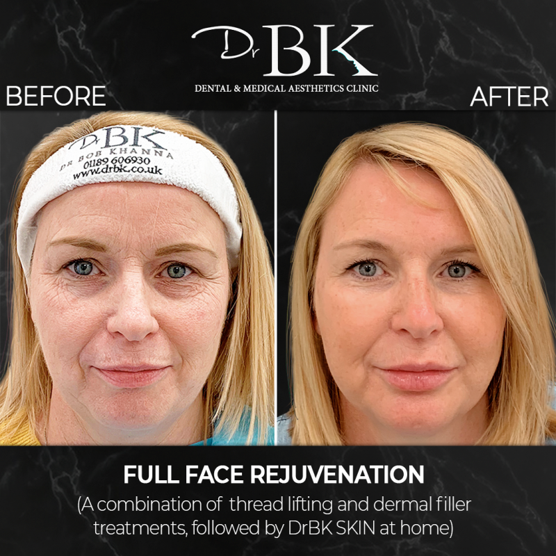 Lisa-Front-BeforeAfter