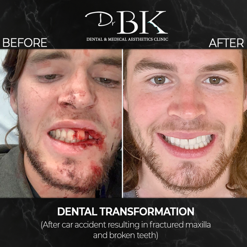 Before and After Dental Treatment at DrBK
