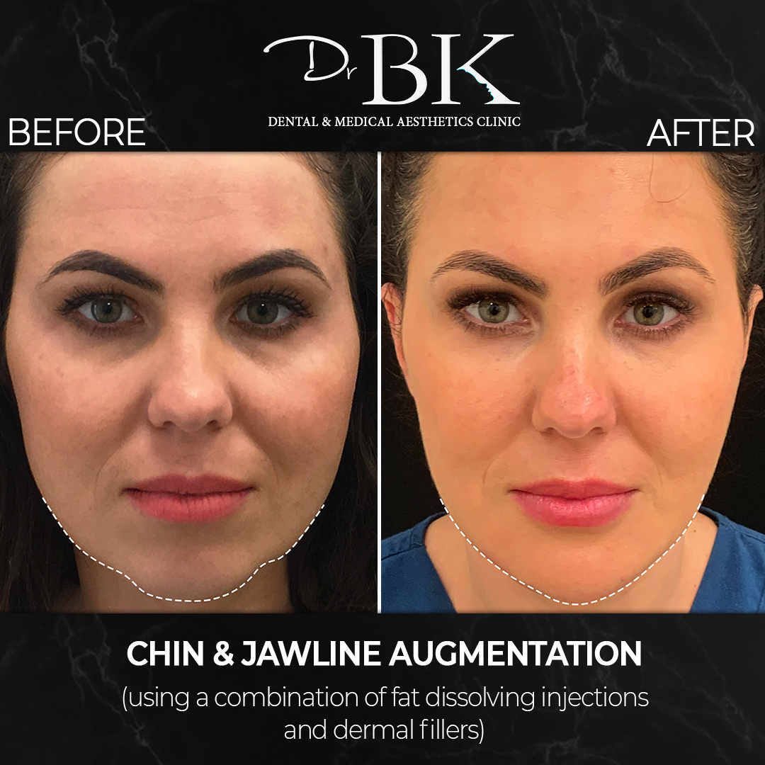 Chin & Jawline Augmentation (using dermal fillers and fat dissolving injections) at DrBK