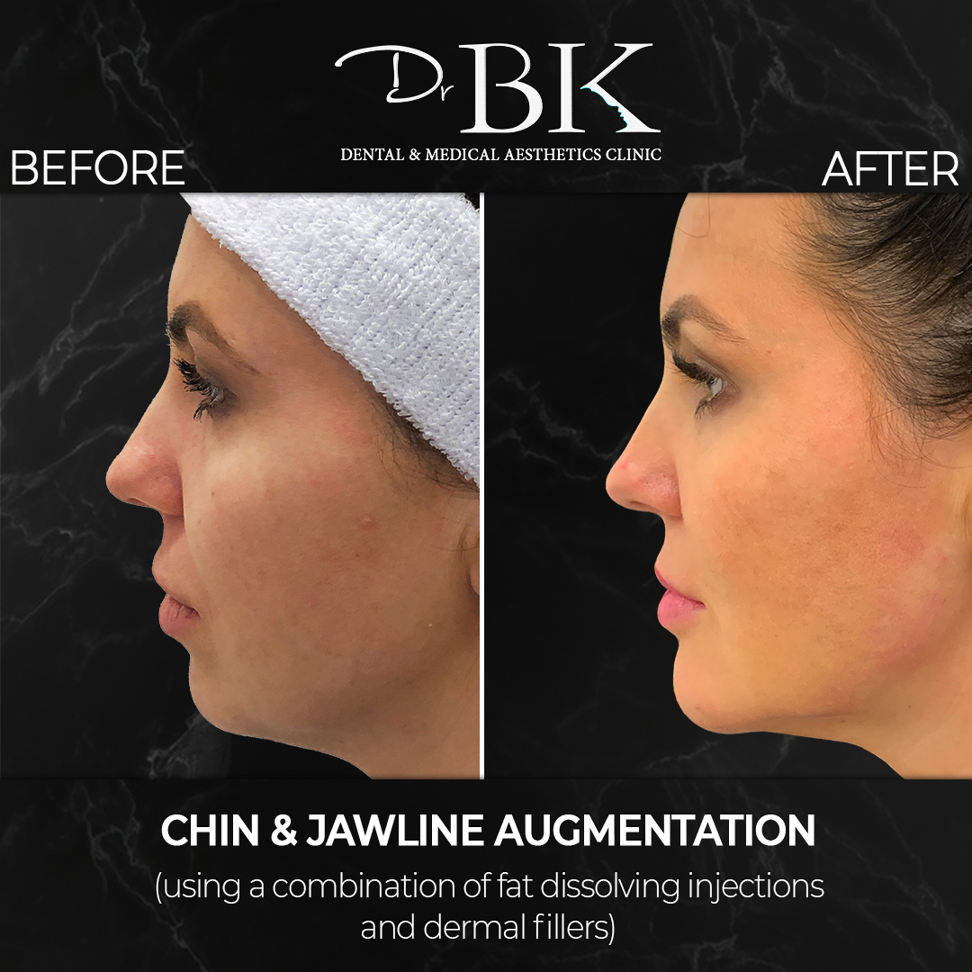 Chin & Jawline Augmentation (using dermal fillers and fat dissolving injections) at DrBK