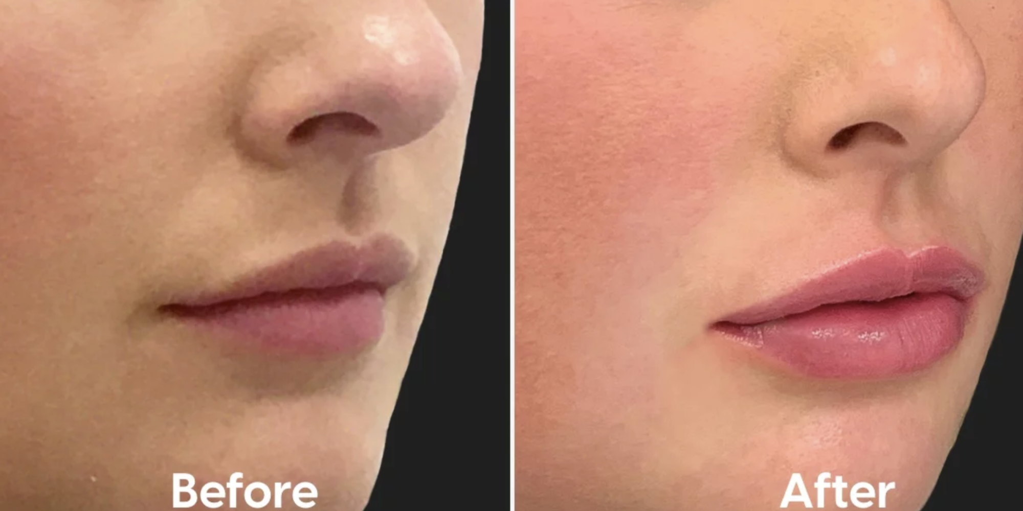 How To Avoid Migrated Lip Filler