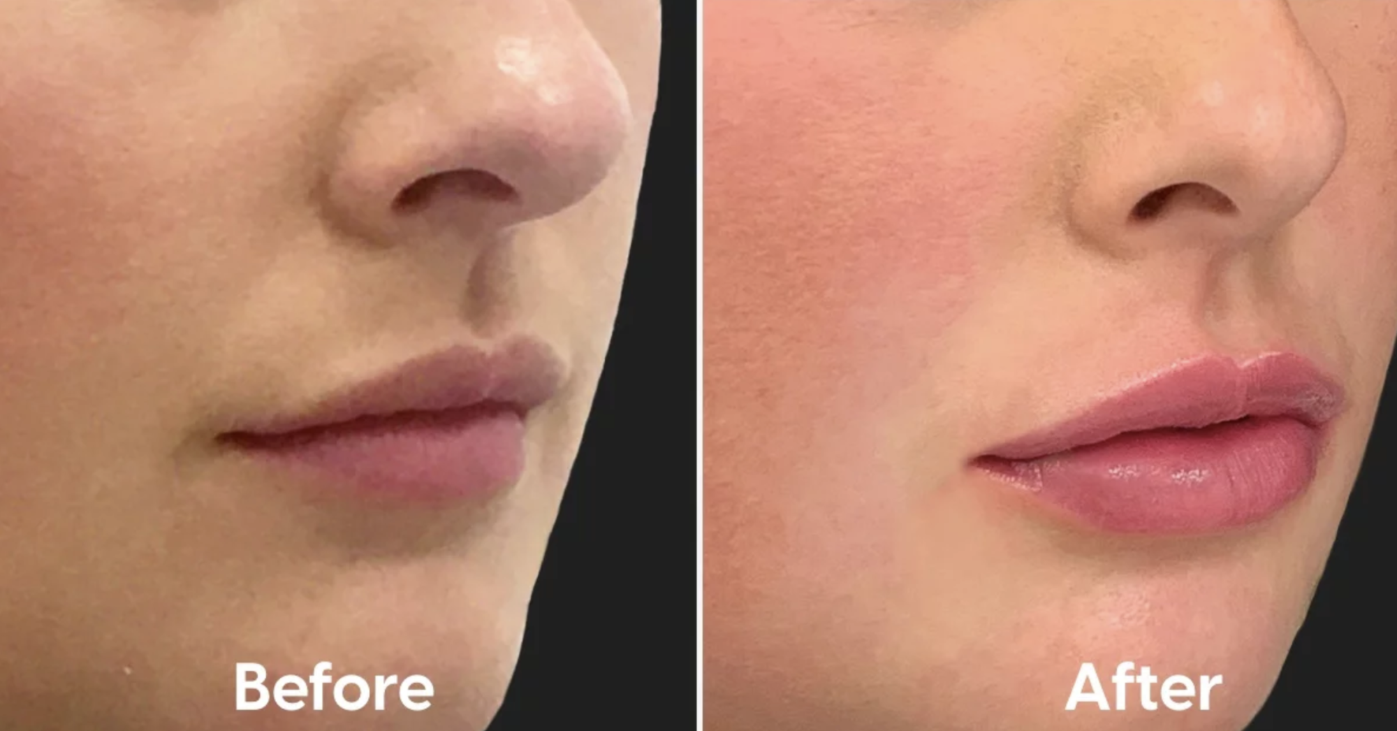 Lip Filler Healing Process What Should It Look Like? by PopSugarBeauty