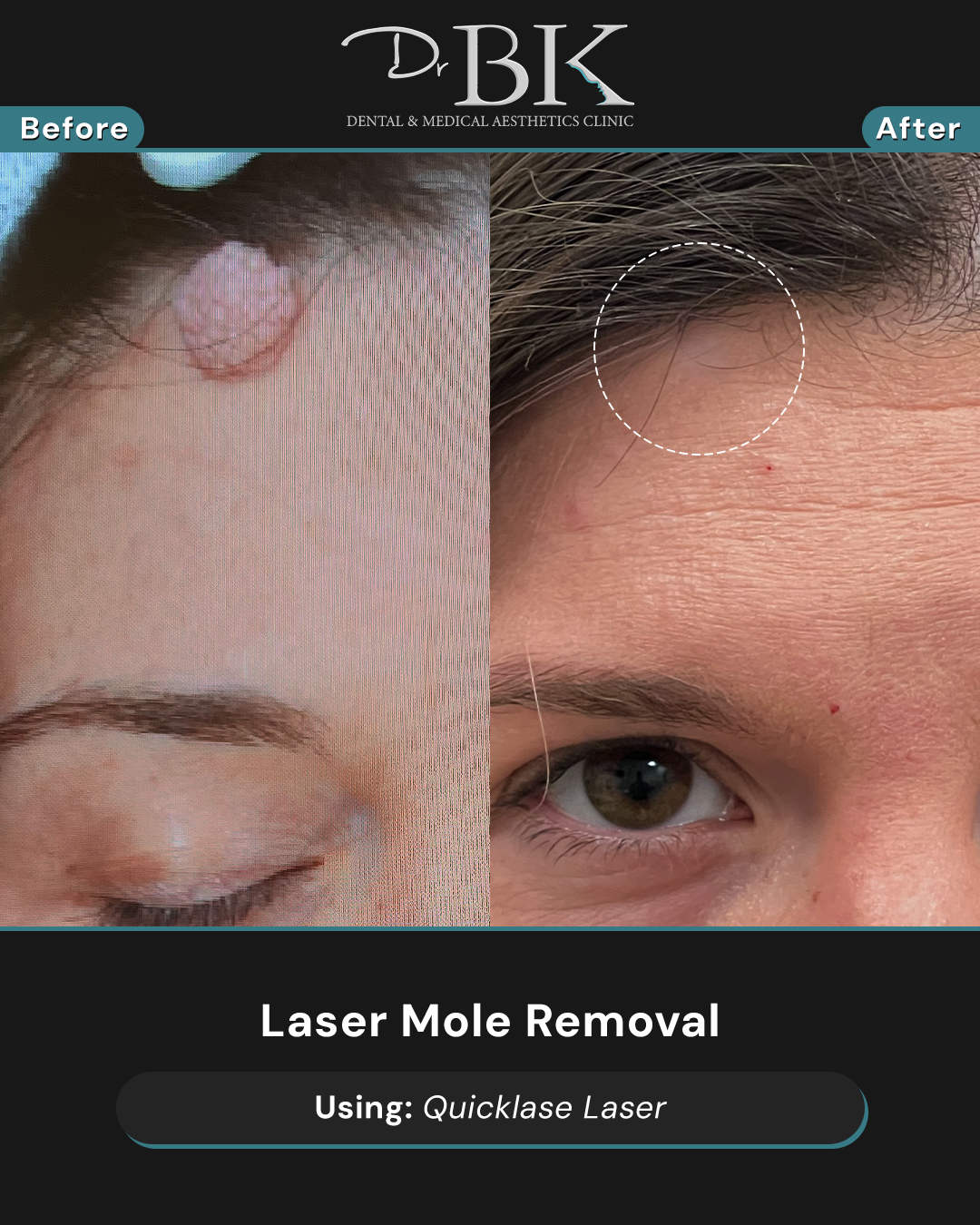 MoleRemovalBeforeAfter MoleRemovalBeforeAfter