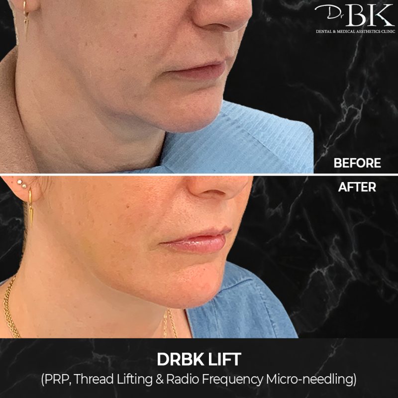 Thread lift for the jowl area Thread lift for the jowl area