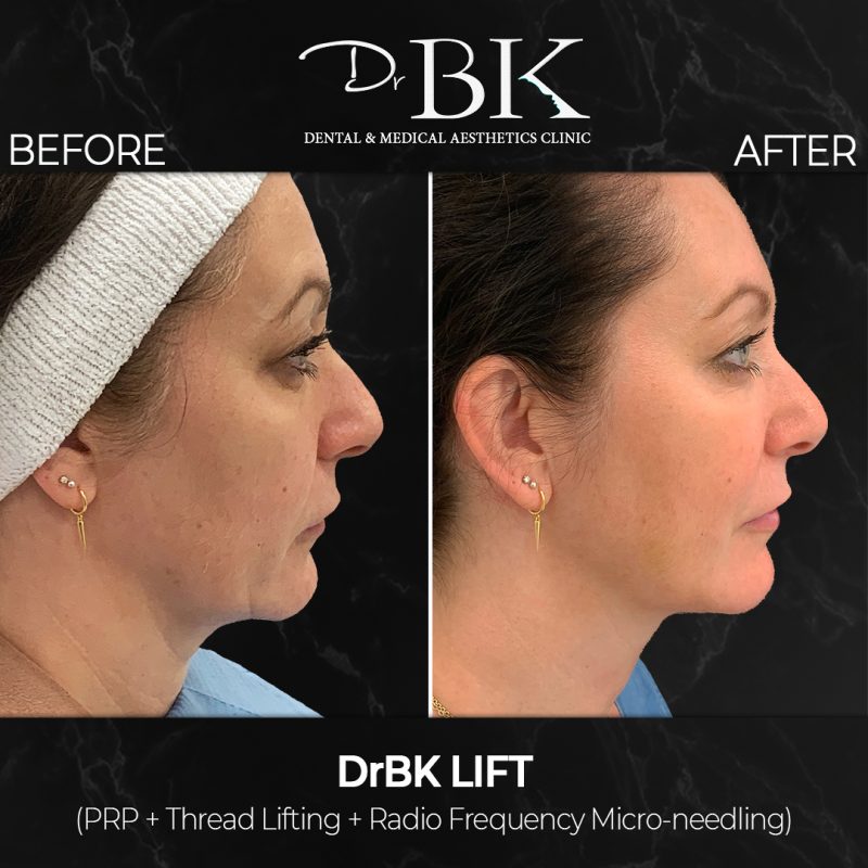 Non-Surgical FaceLift Non-Surgical FaceLift