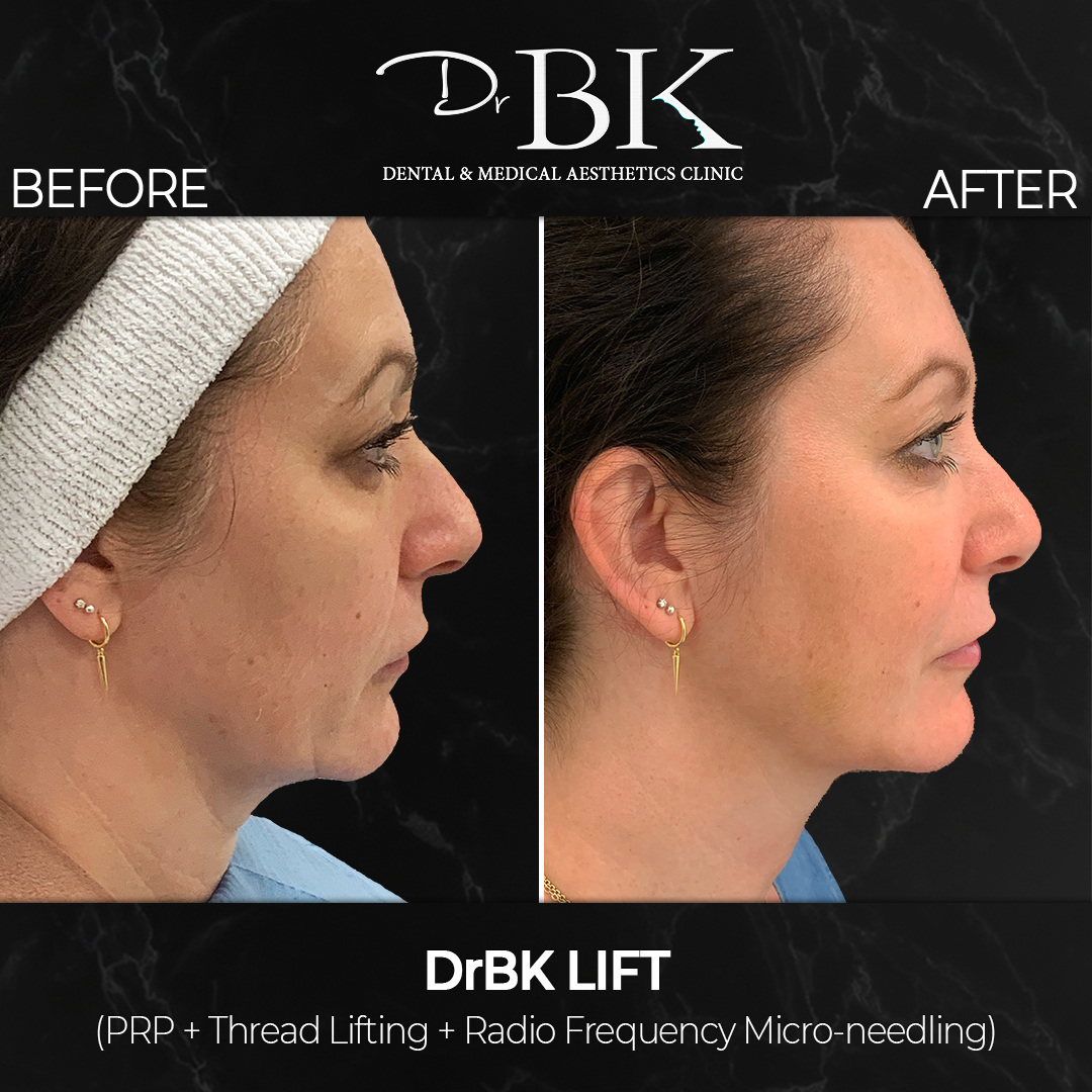 Non-Surgical FaceLift Non-Surgical FaceLift