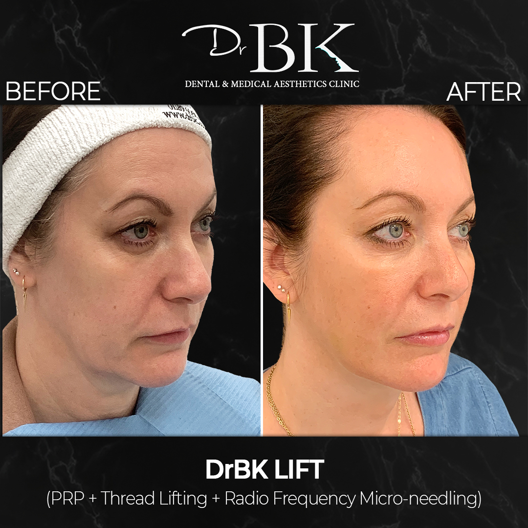 Thread & Lift - The 1st real facelift without surgery