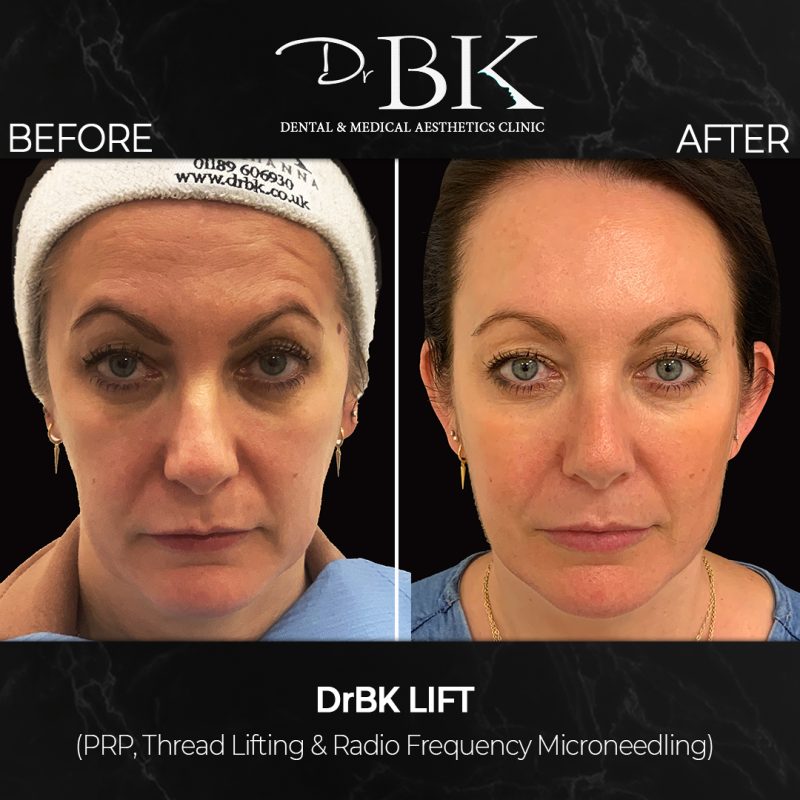 Thread Face Lift NonSurgical Thread Lift DrBK