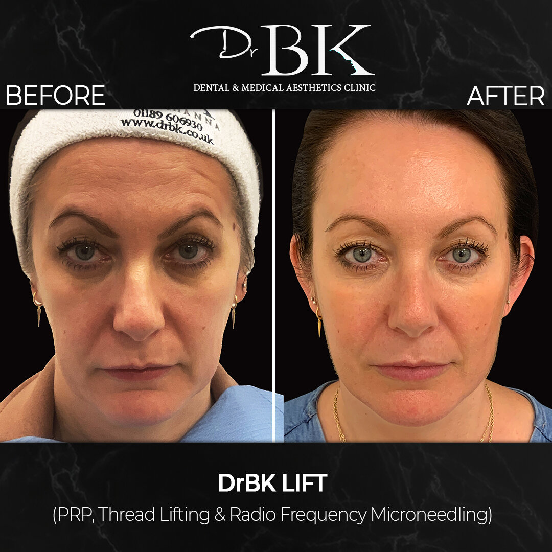 Full face treatment - drbk - threadlifting, cutislift