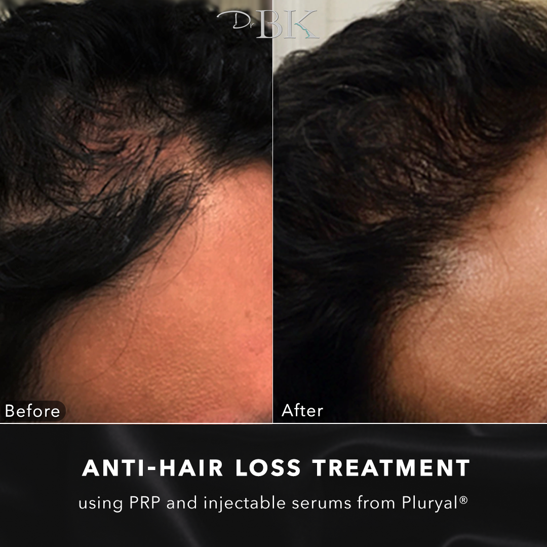 Anti hair loss treatment at DrBK Reading