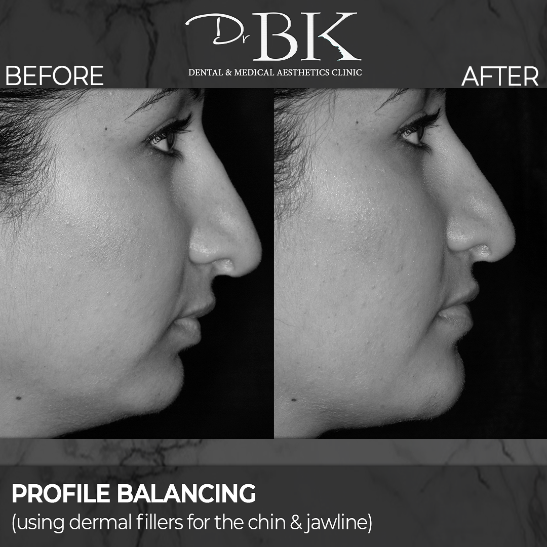 Chin & Jawline Augmentation (using dermal fillers) at DrBK - Before and After Transformation