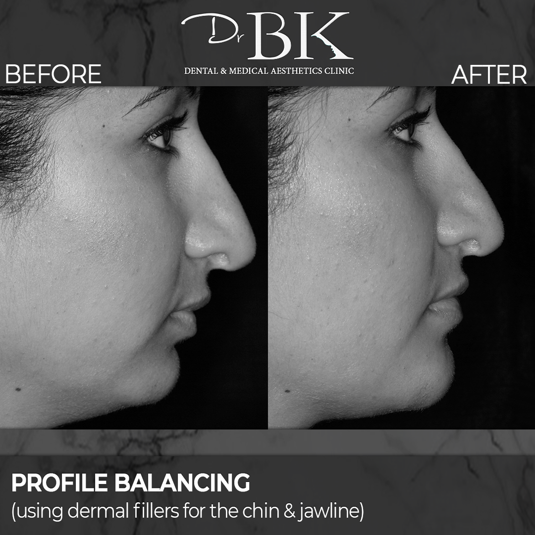 Chin & Jawline Augmentation (using dermal fillers) at DrBK - Before and After Transformation Chin & Jawline Augmentation (using dermal fillers) at DrBK - Before and After Transformation