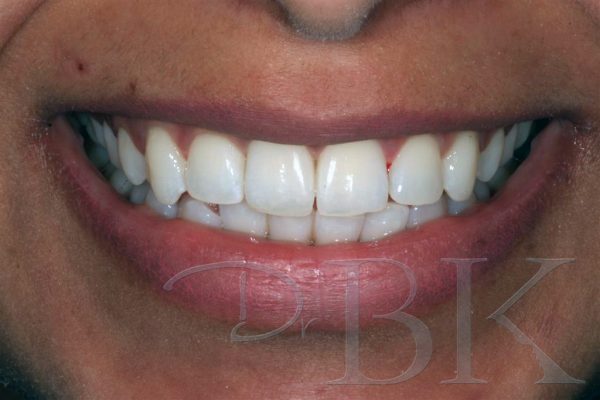 12 Weeks After Orthodontic Treatment with Clear Aligners
