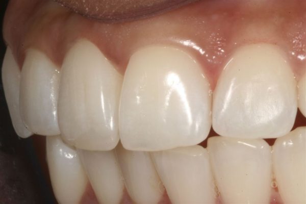 12 Weeks After Orthodontic Treatment with Clear Aligners