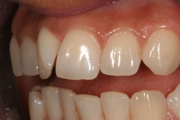 Before Orthodontic Treatment with Smilelign Clear Aligners